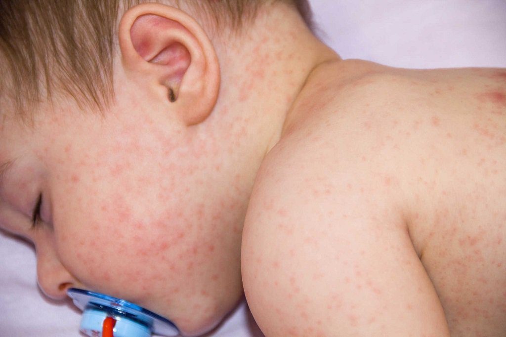 Trẻ khi sốt phát ban cần được xử lý đúng cách để tránh làm bệnh trở nặng, lâu khỏi hơn