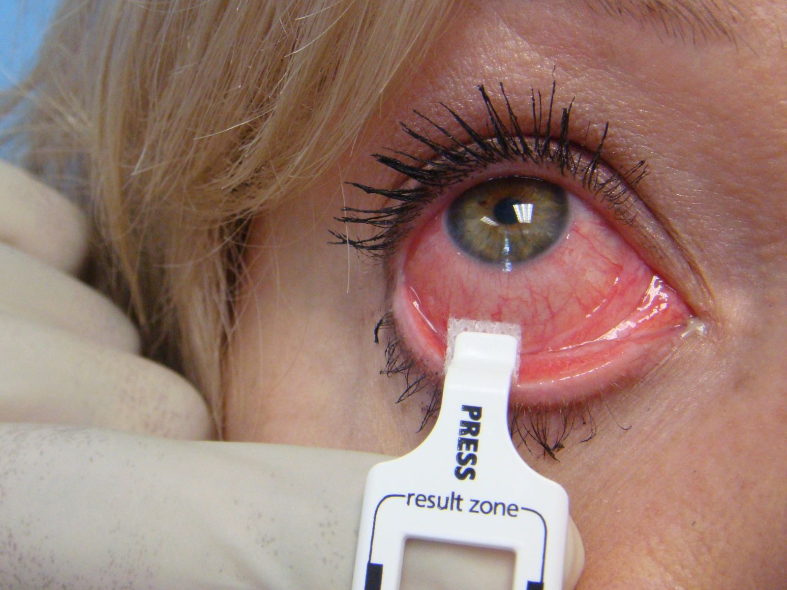 Viêm bờ mi mắt có thể điều trị tại nhà không?