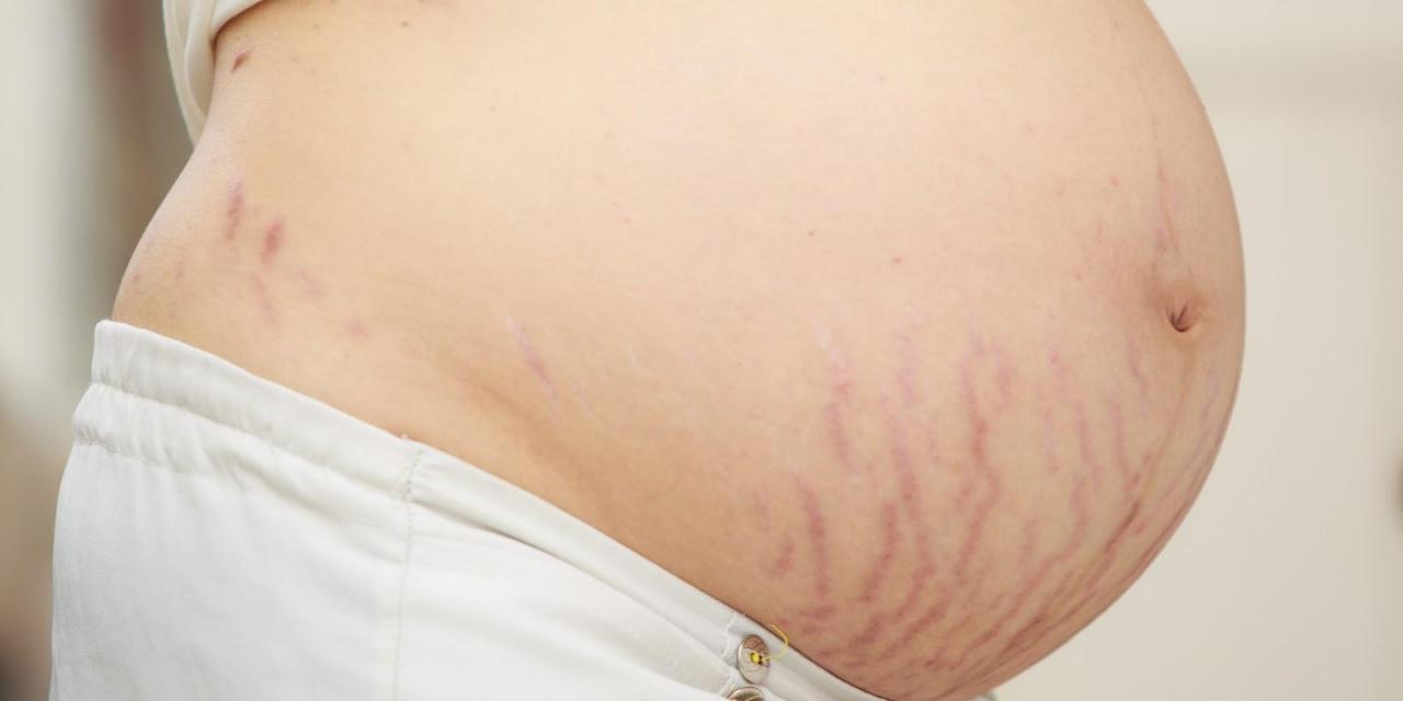 Tăng cân đột ngột khiến mẹ bầu dễ bị rạn da 