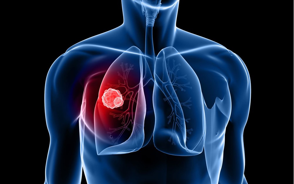Nam giới có tỷ lệ bị ung thư phổi cao hơn nhiều so với nữ giới