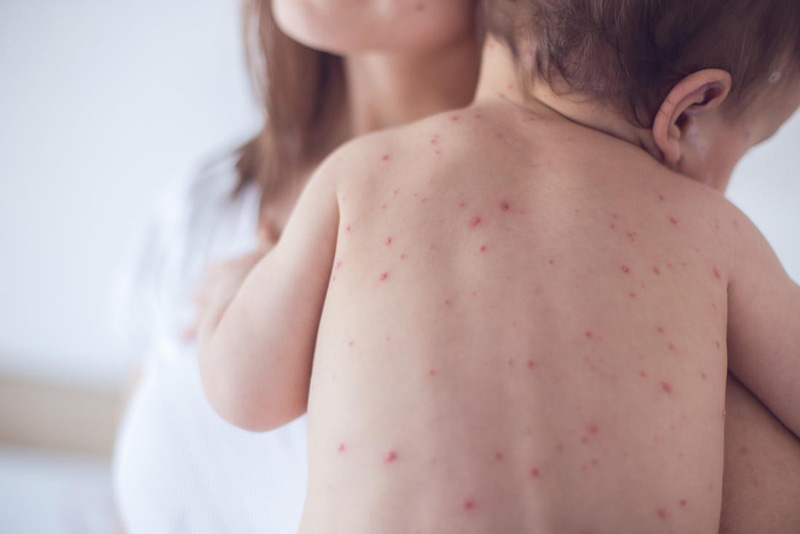Trẻ nhỏ khi bị sốt phát ban sẽ nổi ban khắp người 