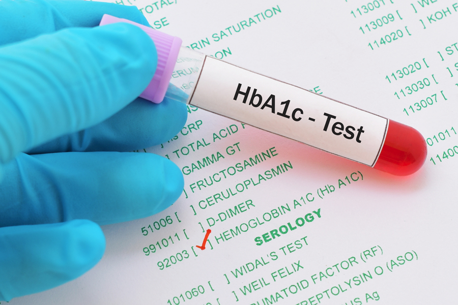 3 phương pháp xét nghiệm quan trọng của tiểu đường là xét nghiệm nước tiểu, đường huyết và chỉ số HbA1C 