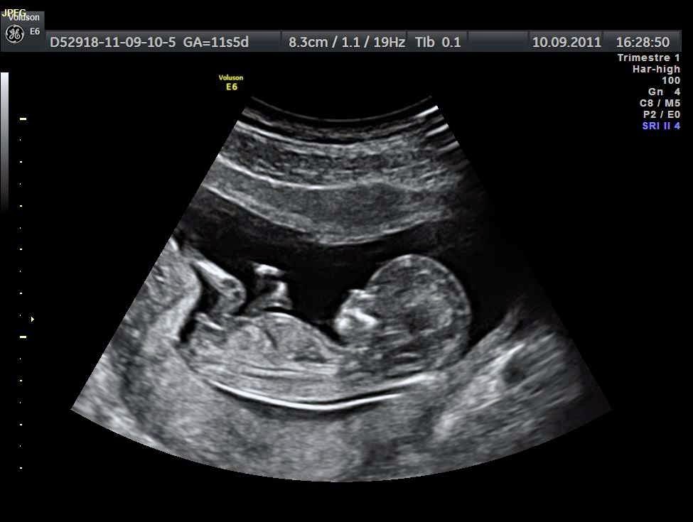 Hình ảnh siêu âm thai 23 tuần của bé trai 