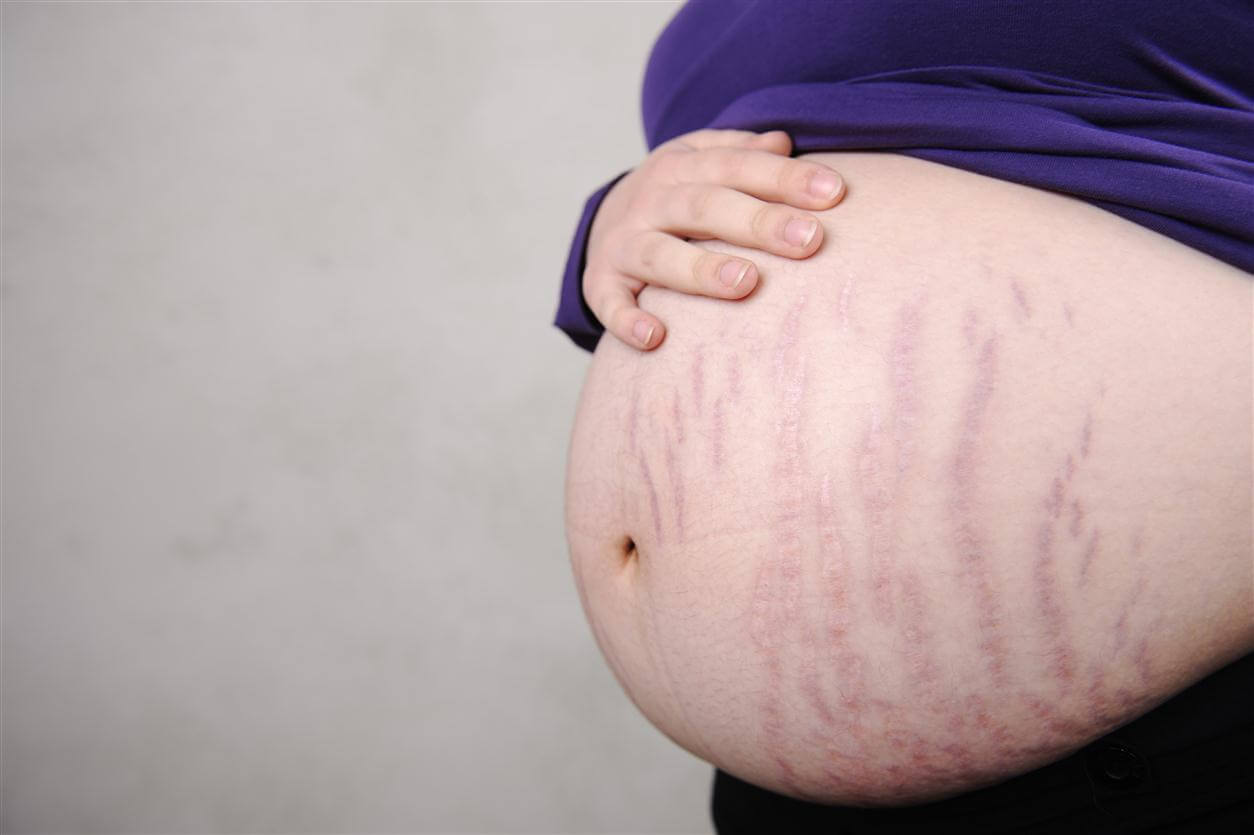 Rạn da là hiện tượng rất thường gặp trong thai kỳ do sự tăng kích thước quá nhanh