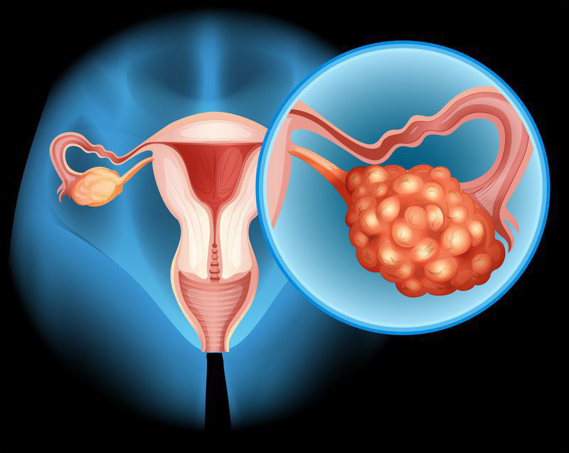 Ung thư buồng trứng nguy hiểm với phụ nữ