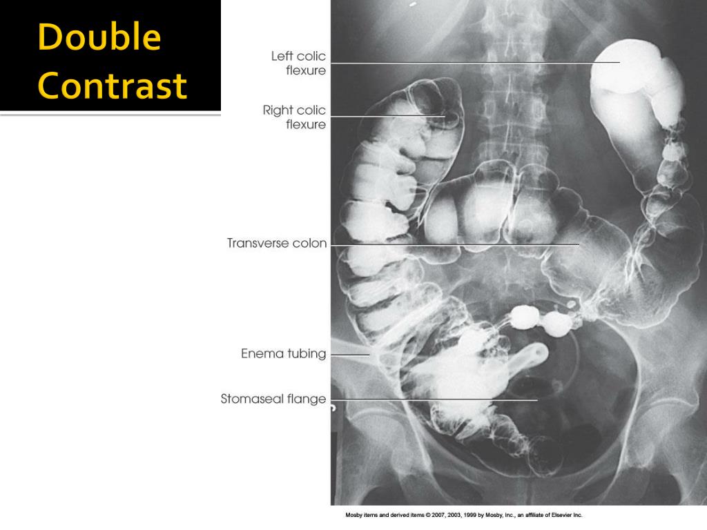 Phương pháp Double-Contrast Barium Enema 