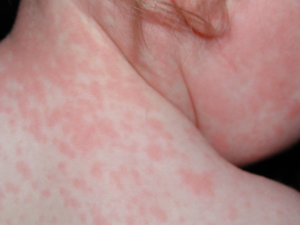 Nổi mẩn đỏ là dấu hiệu của bệnh sốt phát ban
