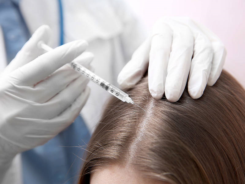 Ngăn rụng tóc và kích thích mọc tóc bằng phương pháp PRP