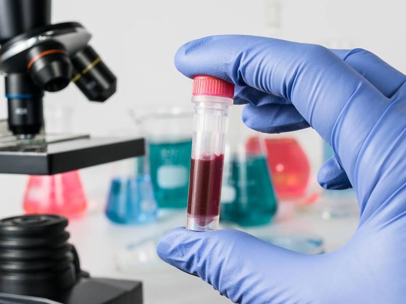Tìm máu ẩn trong phân là xét nghiệm đầu tiên để kiểm tra xem bạn có dương tính với bệnh hay không