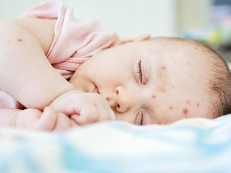 Biểu hiện dễ nhận biết của trẻ bị sốt phát ban
