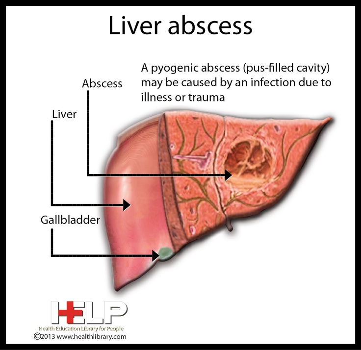Hình ảnh ổ áp xe trong gan. Abscess: ổ áp xe; Liver: gan; Gallbladder: túi mật 