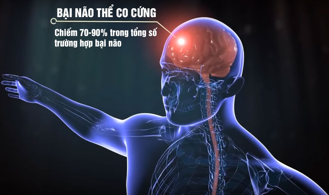 Bại não thể co cứng khá phổ biến ở Việt Nam