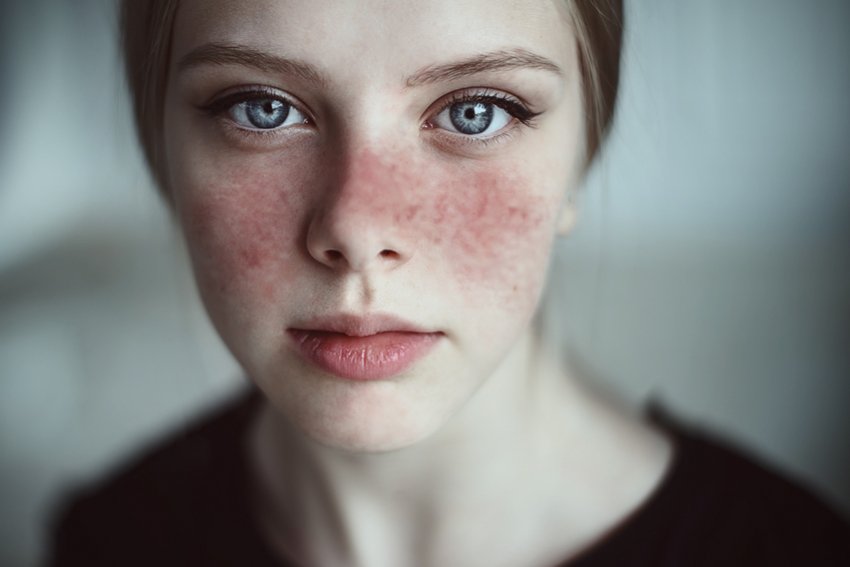 Bệnh lupus ban đỏ nguy hiểm bởi các biến chứng nguy hiểm 