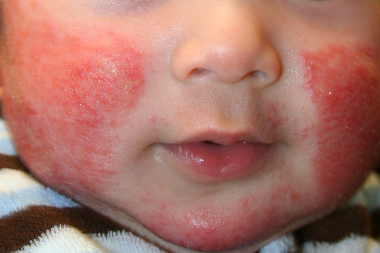 Trẻ nhỏ rất dễ bị viêm da dị ứng
