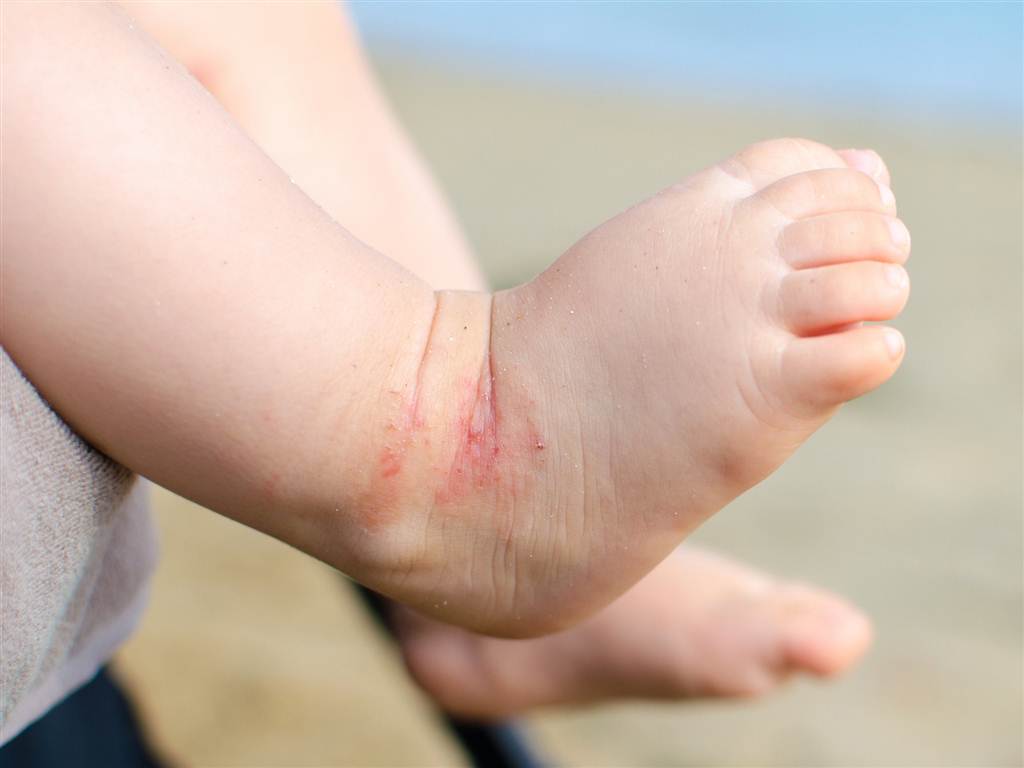 Trẻ nhỏ rất dễ bị viêm da 