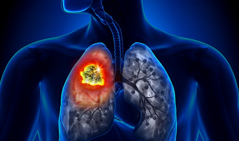 Ung thư phổi là loại ung thư phổ biến ở độ tuổi ngoài 40 