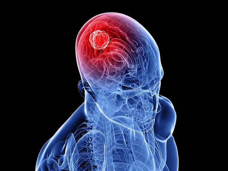 Đau đầu không dứt là một triệu chứng thường thấy ở bệnh ung thư não