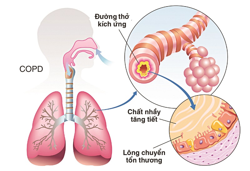 Những tổn thương bên trong đường thở gây nên tình trạng bệnh tắc phổi mãn tính