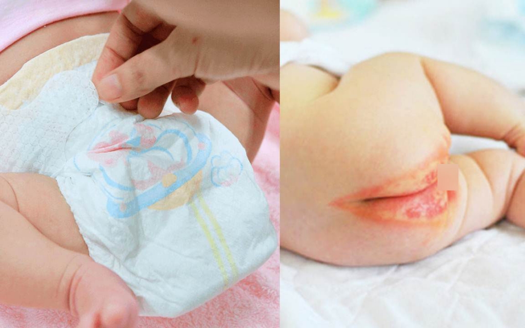 Nếu không đóng bỉm đúng cách, đóng bỉm liên tục 24/24 sẽ khiến bé bị hăm da, viêm da