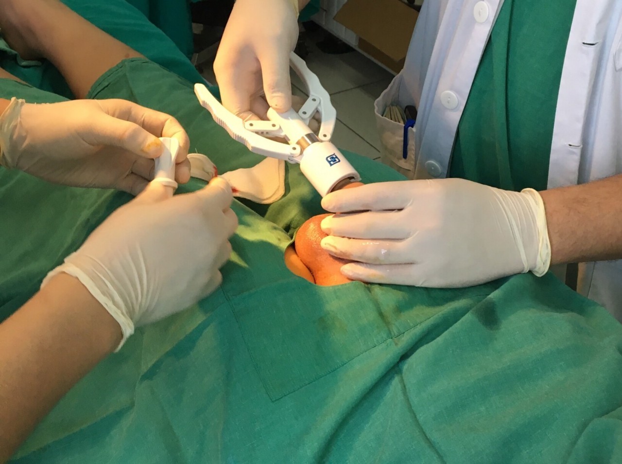 Hẹp bao quy đầu gặp phải ở người lớn thường cần đến việc phẫu thuật cắt bao quy đầu để điều trị triệt để 