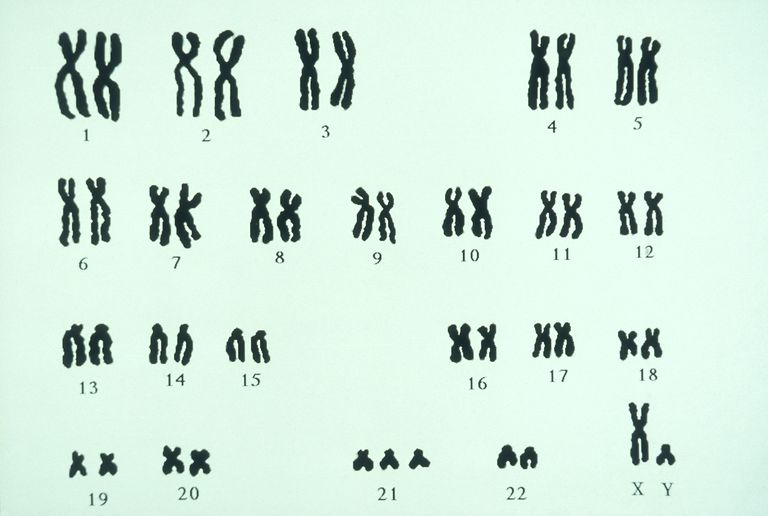 Hội chứng Down phổ biến nhất là ba nhiễm sắc thể 21 