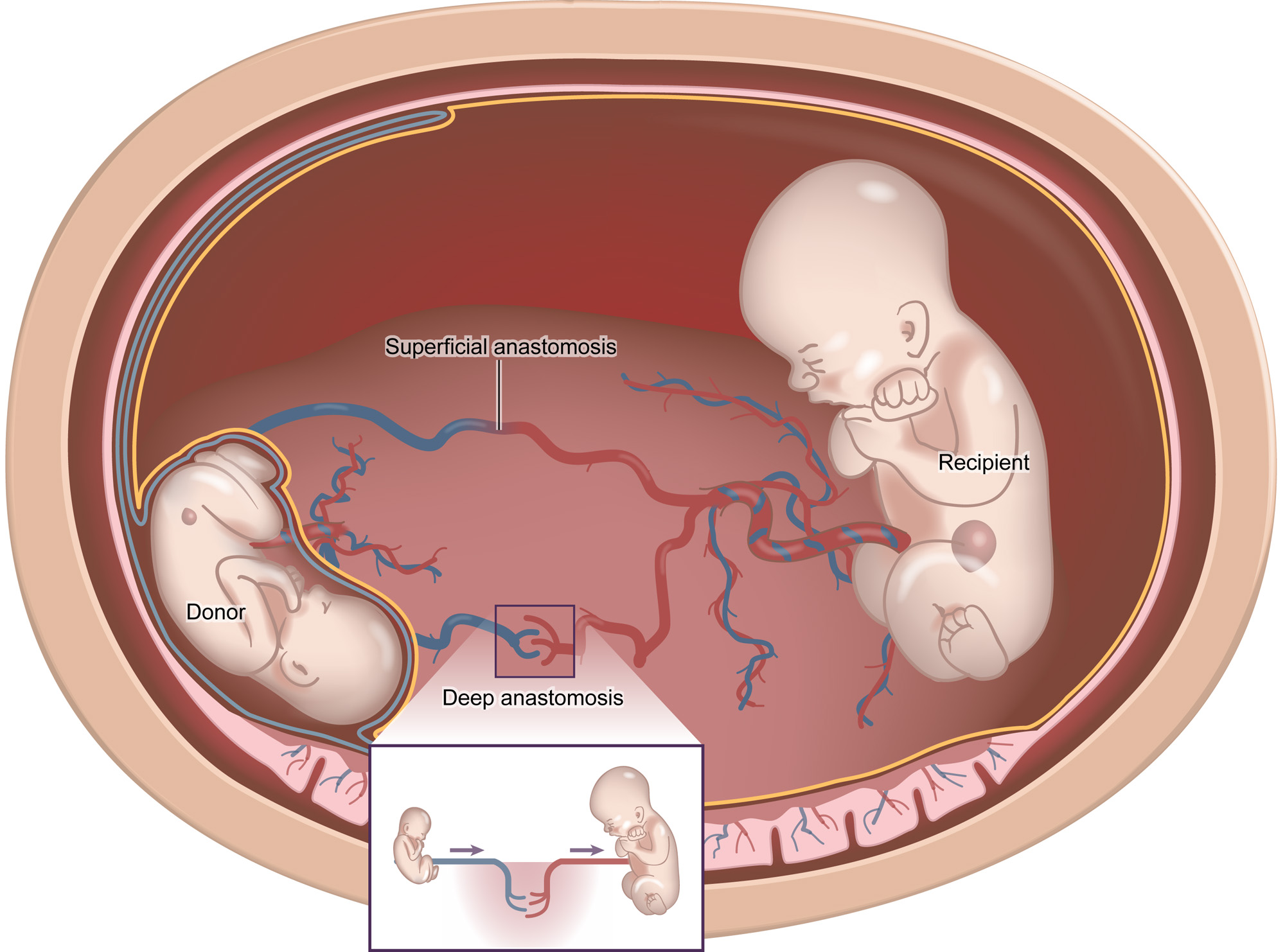 Truyền máu song thai thường dễ xảy ra ở những cặp sinh đôi cùng trứng