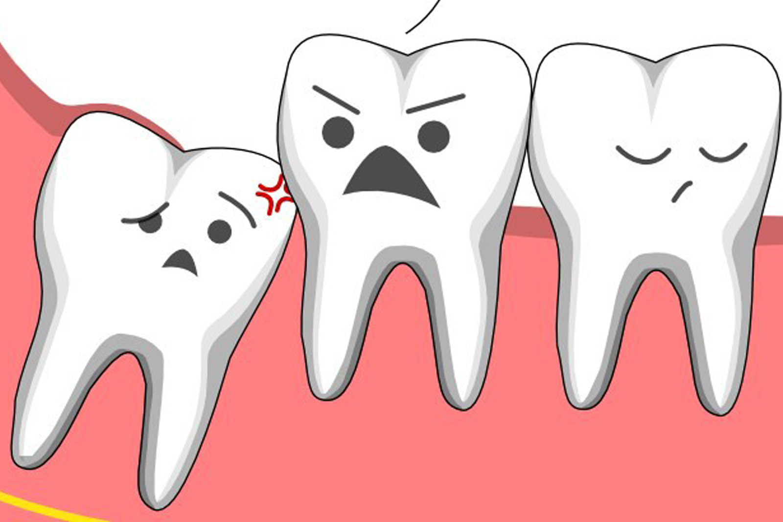 Răng khôn mọc lệch có ảnh hưởng rất lớn đến những chiếc răng bên cạnh