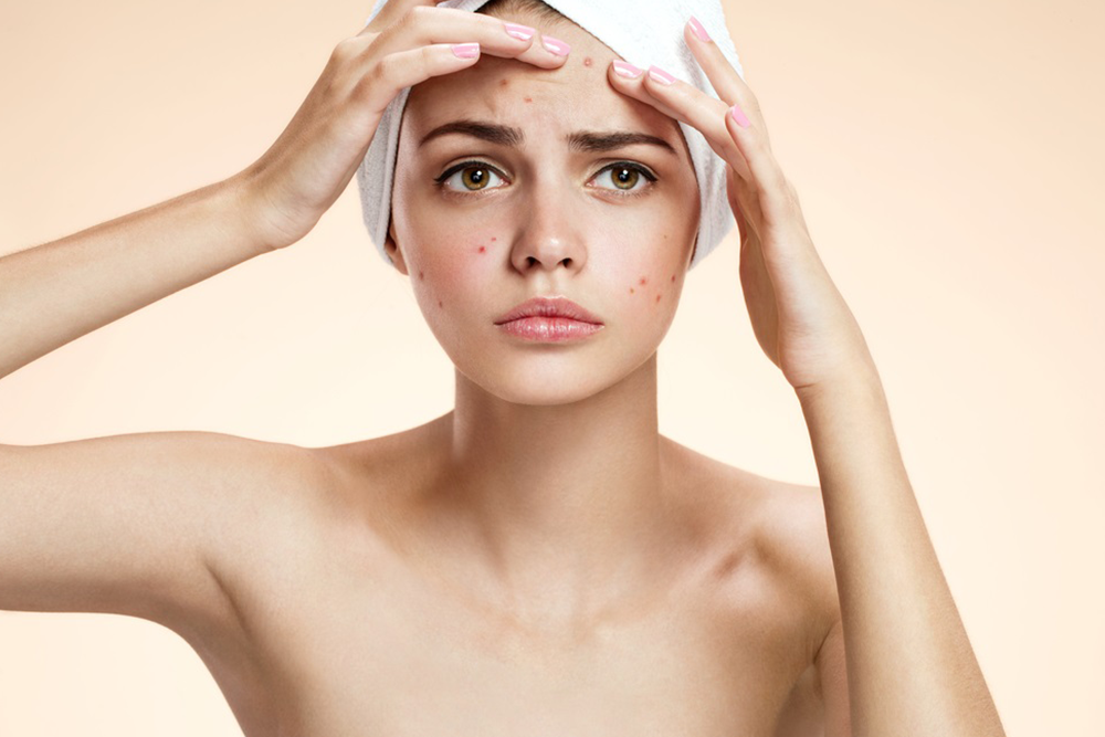 Thải độc gan kém khiến cơ thể bị tích tụ độc tố thường gây ra biểu hiện ngoài da là mụn làm bạn khó chịu, tự ti