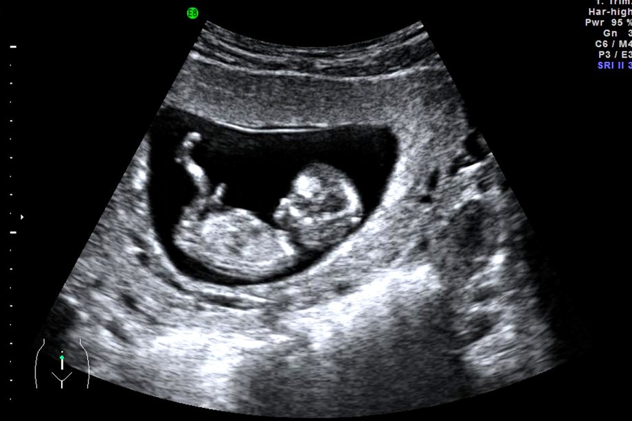 Hình ảnh siêu âm thai 3 tháng đầu