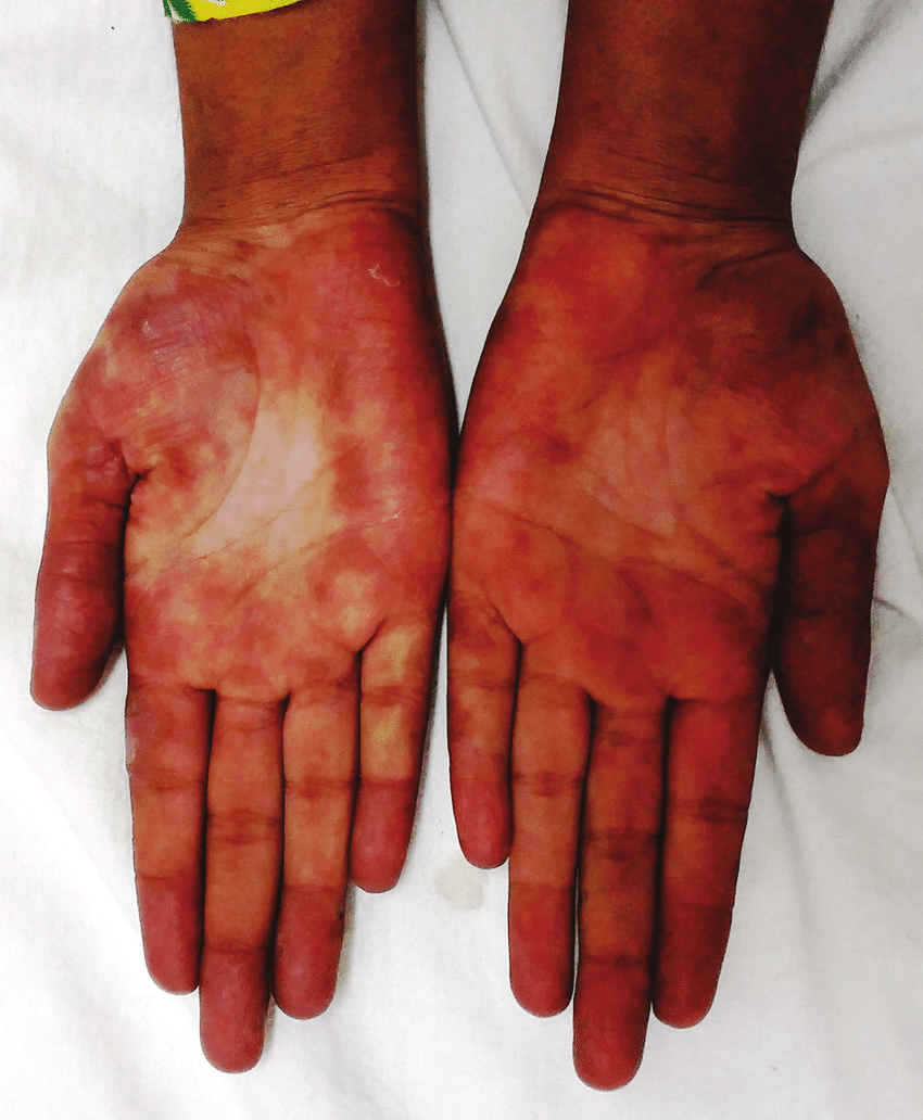 Các yếu tố môi trường tạo điều kiện phát triển bệnh lupus ban đỏ 