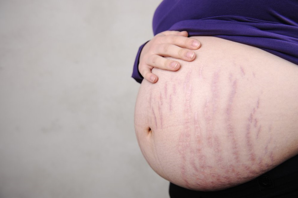 Rạn da khi mang bầu và sau khi sinh là nỗi lo sợ của nhiều chị em phụ nữ