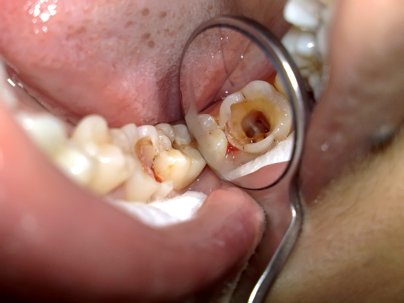 Sâu răng ảnh hưởng tiêu cực đến sức khỏe và cuộc sống