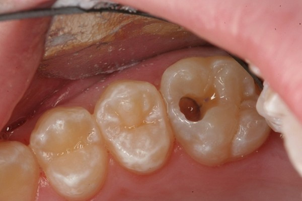 Nên sớm điều trị sâu răng ở những giai đoạn đầu