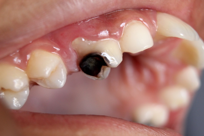 Nha sĩ sẽ thăm khám và chỉ định phương pháp điều trị sâu răng phù hợp nhất cho người bệnh 
