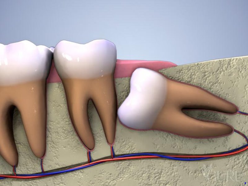 Răng khôn mọc ngầm thường mọc lệch làm ảnh hưởng đến sức khỏe răng miệng, thẩm mỹ 