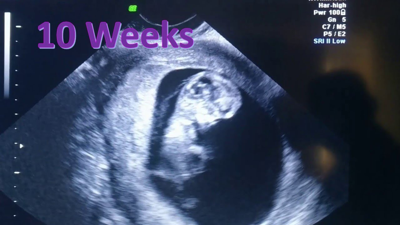 Hình ảnh thai nhi được 10 tuần tuổi qua siêu âm