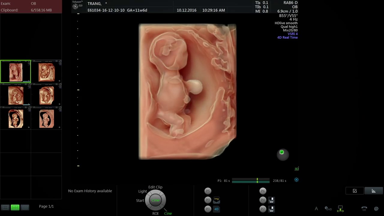 Hình ảnh siêu âm thai 11 tuần tuổi 
