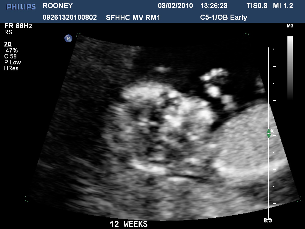 Hình ảnh siêu âm thai nhi 12 tuần tuổi 