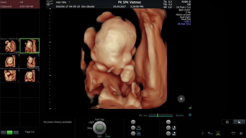 Hình ảnh siêu âm thai 24 tuần tuổi 