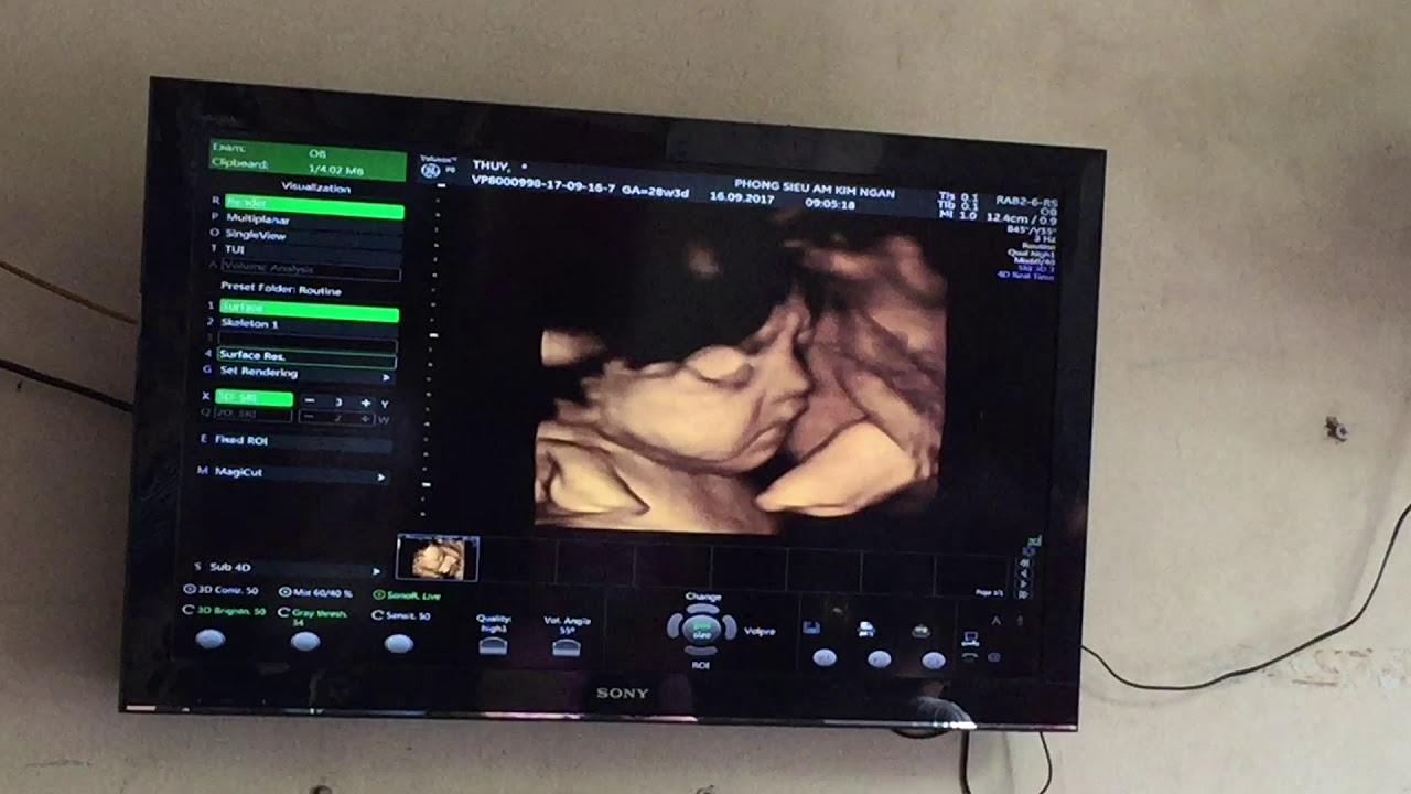 Hình ảnh siêu âm thai tuần 28 với những chi tiết về cơ thể bé được thể hiện rõ rệt