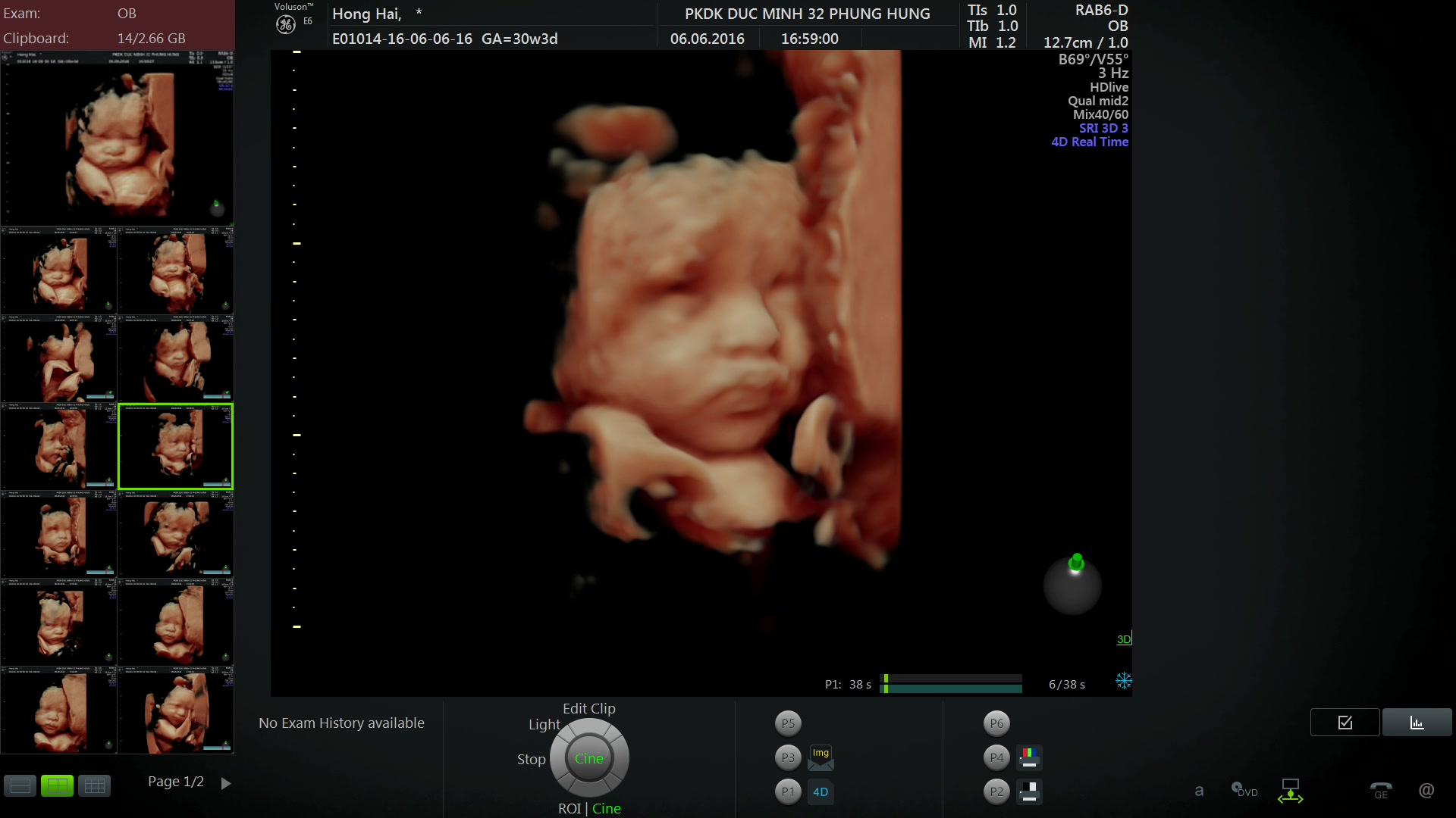 Mẹ bầu có thể chọn siêu âm 4D nếu muốn để nhìn rõ sự phát triển của trẻ