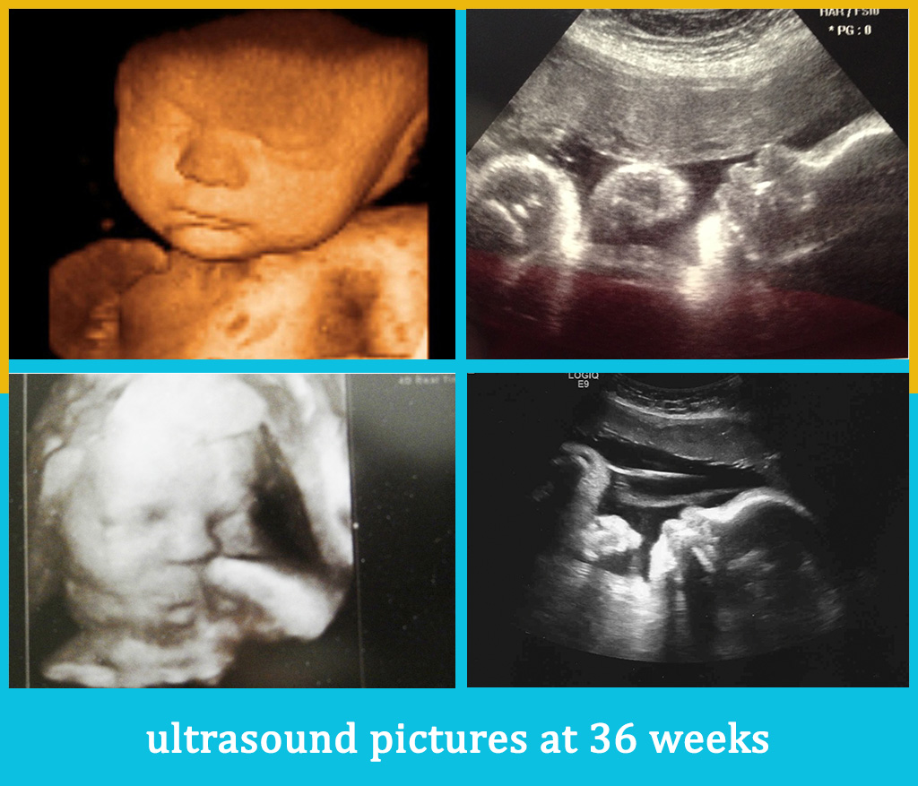 Hình ảnh siêu âm thai 36 tuần
