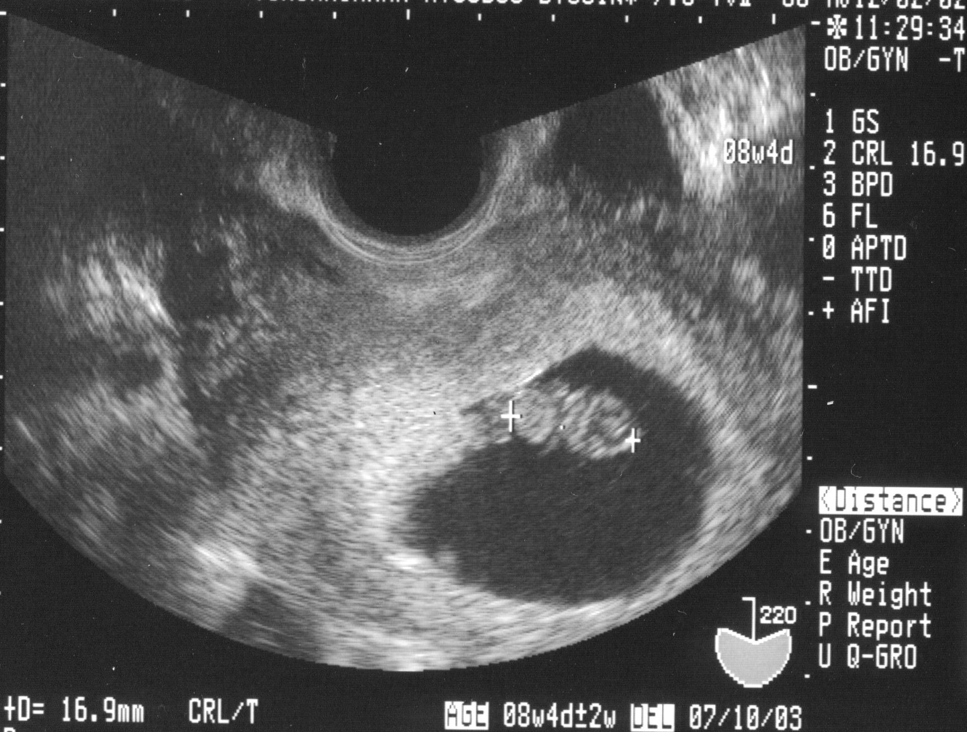 Ở tuần thai thứ 6, kích thước của bé rất nhỏ, chân bé co lại rất khó để xác định kích thước chuẩn