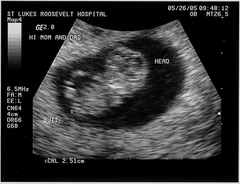 Hình ảnh siêu âm thai 9 tuần tuổi
