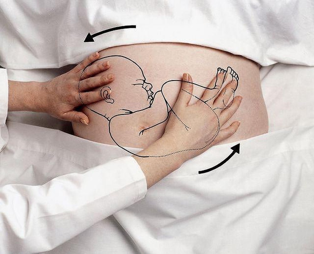 Ngôi thai nghịch gây khó khăn cho việc sinh thường