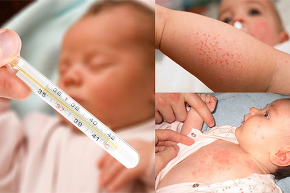 Sốt phát ban thường xuất hiện ở trẻ nhỏ từ 6 tháng đến 12 tháng tuổi