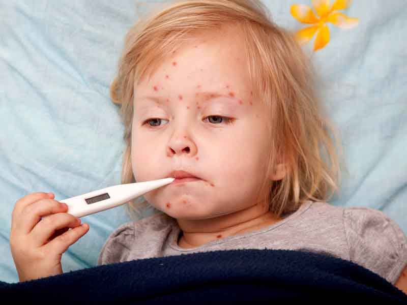 Trẻ nhỏ rất dễ bị virus sốt phát ban tấn công
