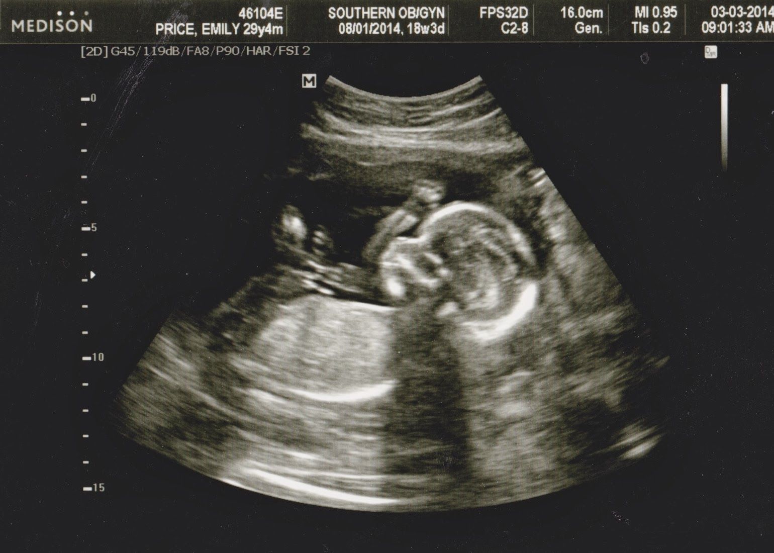 Hình ảnh siêu âm thai nhi 18 tuần tuổi