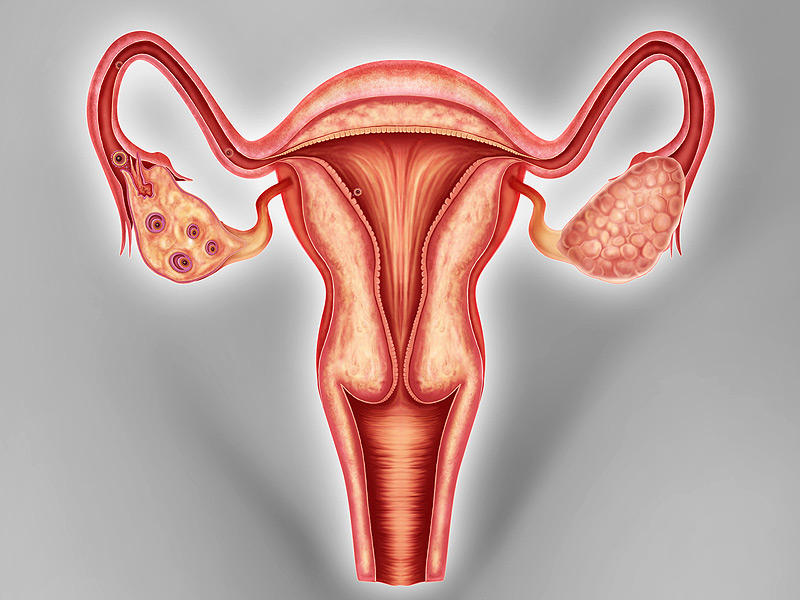 Đau bụng và đầy hơi là biểu hiện ung thư buồng trứng trong giai đoạn 1 dễ bị bỏ qua 