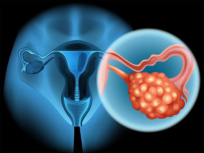 Ung thư buồng trứng tại giai đoạn đầu có thể chữa khỏi được không?